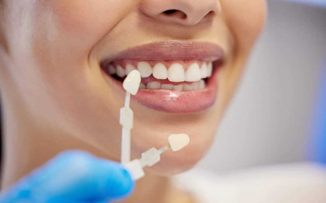 Can You Get Crowns on Front Teeth?